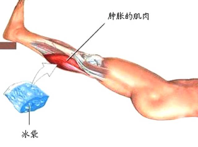 运动损伤针灸治疗方法举例,运动损伤的针灸