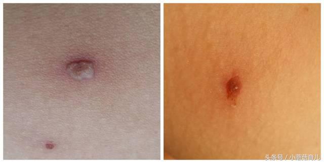 水痘有可能突然好了么,水痘高发易中招