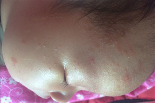 婴儿湿疹防治小绝招,治湿疹绝招视频