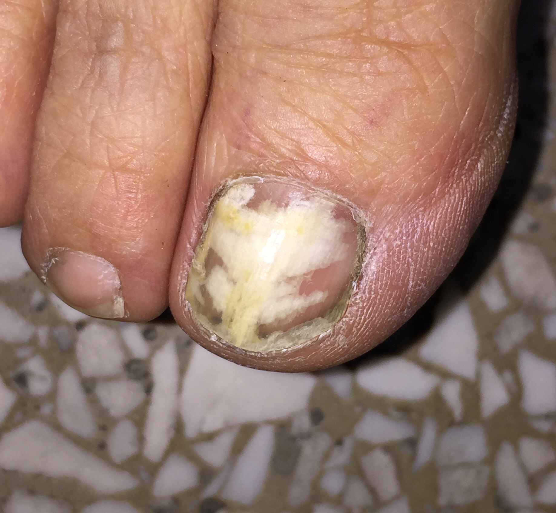 指甲里面莫名其妙长出了一根黑刺,指甲上莫名其妙有一道白色印子