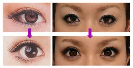 下眼睑下垂术后眼睛会恢复吗,眼睑下至手术前后对比图
