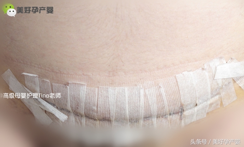 剖腹产伤口纱布怎么撒掉不疼,剖腹产宝妈伤口贴多长时间揭下来