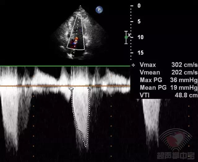 超声肥厚心肌病视频教学,梗阻性肥厚型心肌病消融术