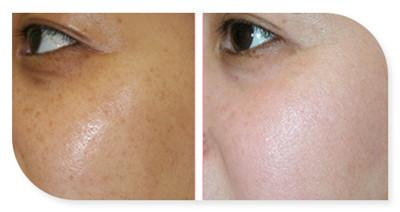 激光后色素沉着会退吗,激光脱毛会色素沉着吗