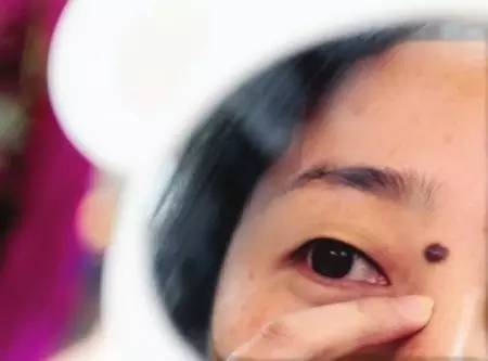 西京医院点痣哪个医生好,西京医院祛痣前后对比