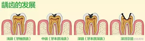 宝宝龋齿原因有哪些？跟奶粉有关系吗？