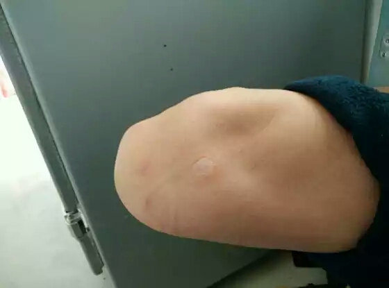 残疾朋友须要注意了：硅胶套，我须要配戴吗？