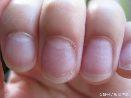 小孩灰指甲初期症状,手上有灰指甲的症状