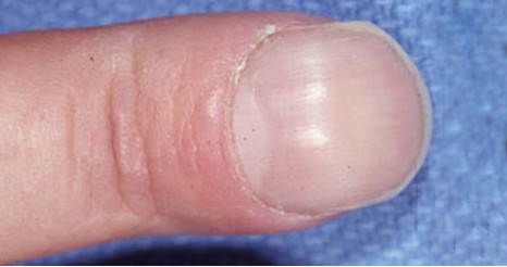 观手知健康指甲有白点怎么回事,当指甲发绿发脓的时候要怎么处理