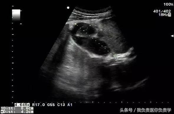 楂樻墜杩涢樁鑵拌吂璁粌,鑳嗗泭缁撶煶绌垮瓟鐥囩姸