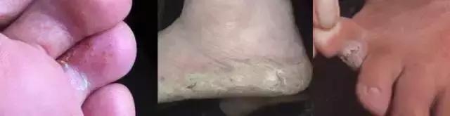 有脚气要分手吗,有脚气要不要分手