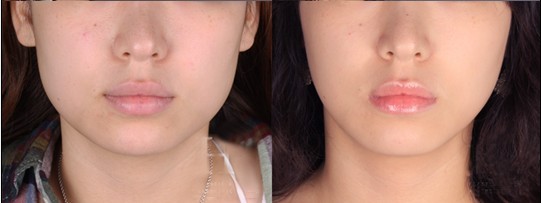 瘦脸针一个月没效果多久才能补打,瘦脸针打完多久能达到最佳效果