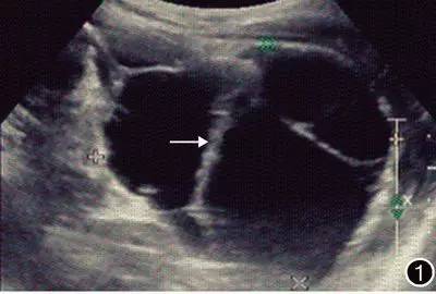 不明原因腹痛胰腺,右上腹痛与胰腺疾病有关系吗