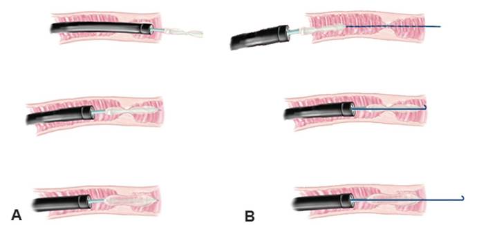 克罗恩病内镜严重程度指数,克罗恩病内镜检查是怎么样的