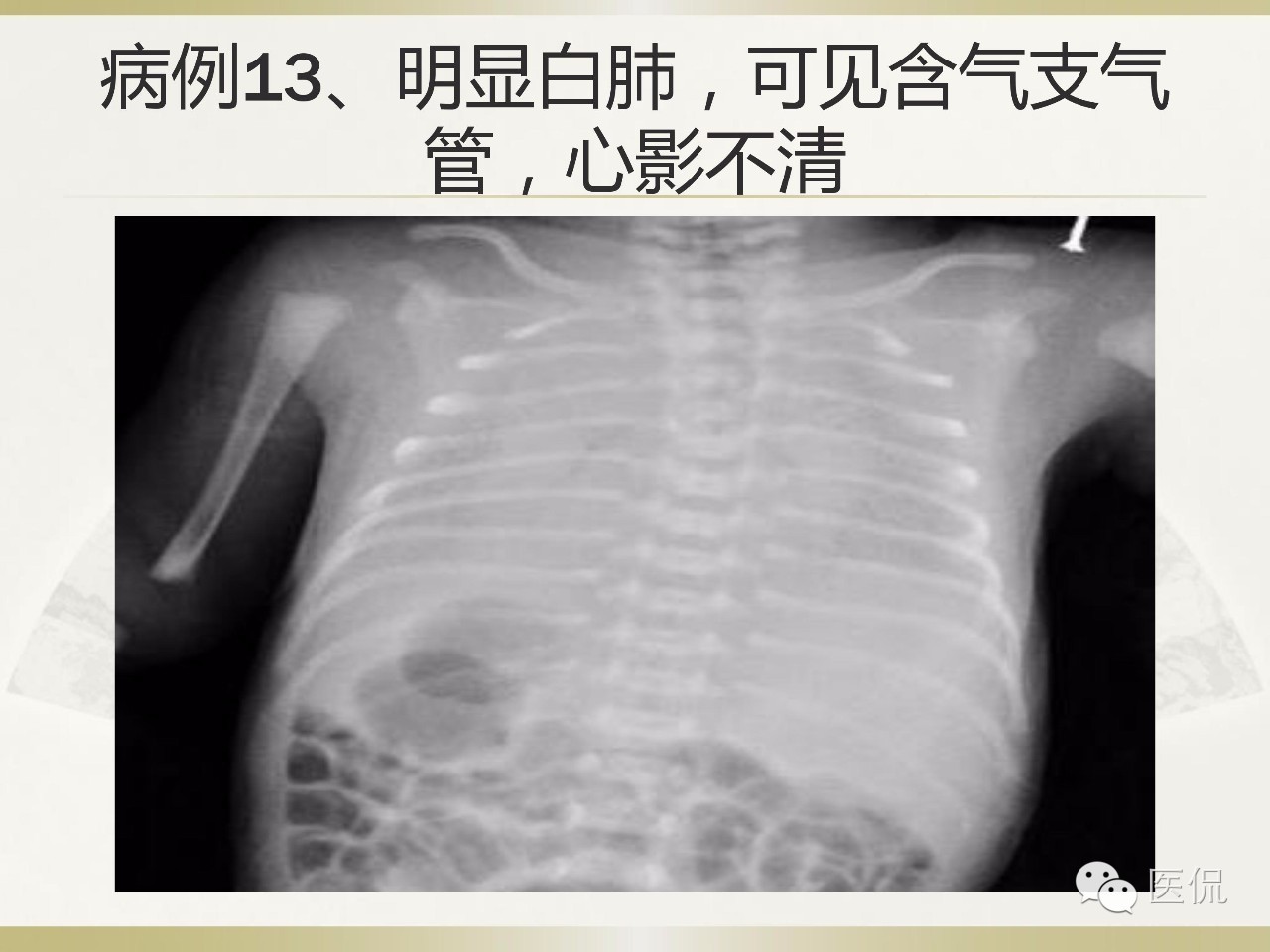 「资料丨医看分享」南边老师肺部群：新生儿透明膜病（HMD）医学影像