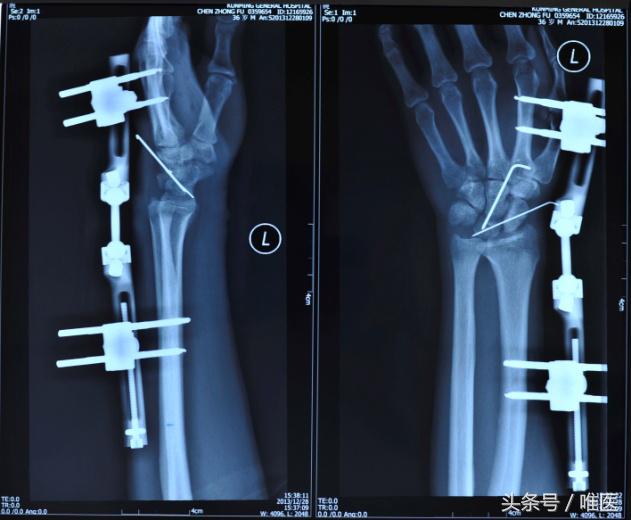 月骨舟骨半脱位手术,手腕舟骨月骨周围脱位要多久康复