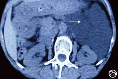 不明原因腹痛胰腺,右上腹痛与胰腺疾病有关系吗