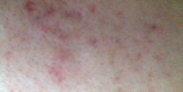 真正祛痘印有效的方法,最简单有效祛痘印的方法