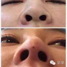 林允是不是整鼻子了,林允隆鼻过吗