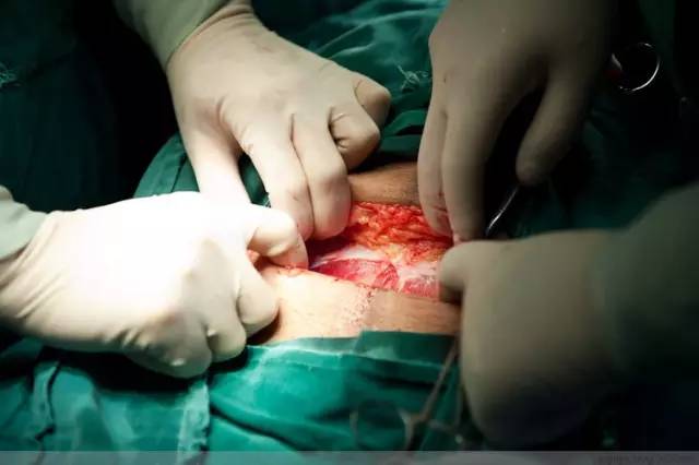 剖腹产恢复很好的照片,剖腹产完全恢复照片