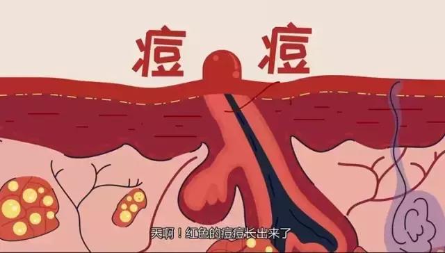 协和治疗黑头粉刺,协和医院皮肤科黑头