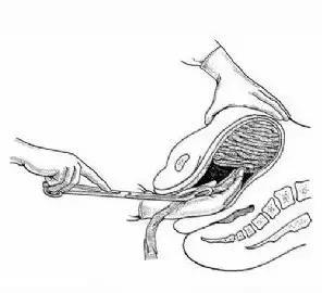 纱布填塞止血的正确方法,纱布止血属于什么止血法