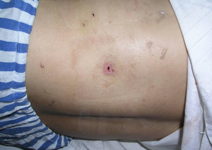 微创肾镜下肾结石碎石取石术,经皮肾镜肾结石激光碎石全过程