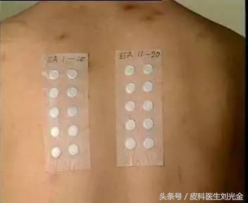 过敏原检测都能查出什么过敏原,查过敏原有哪种方法