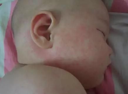 爷爷给2岁孙子扎针放血治抽搐,爷爷给孙子扎针放血治抽搐