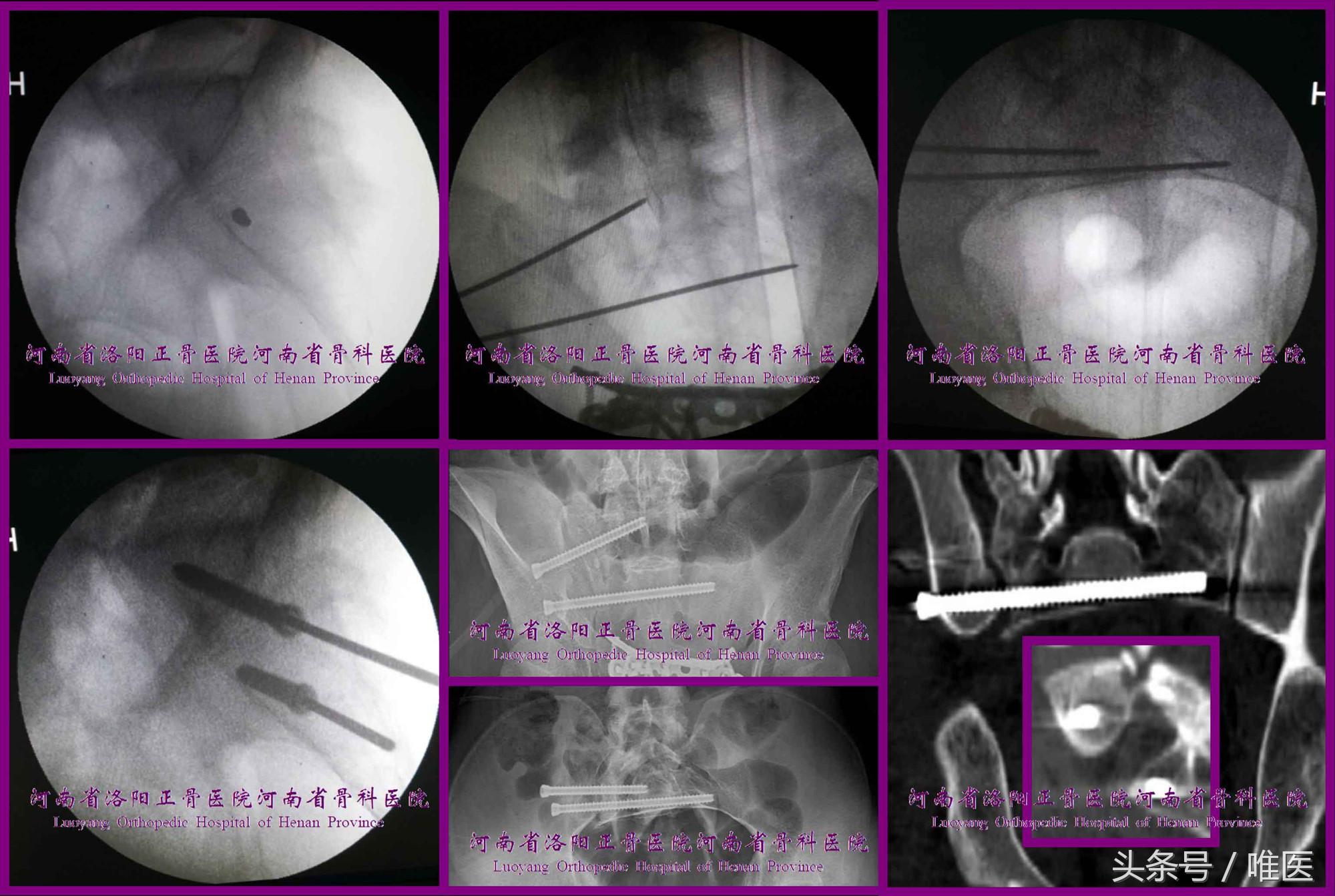 骶髂关节螺钉植入,骶髂关节螺钉手术技巧