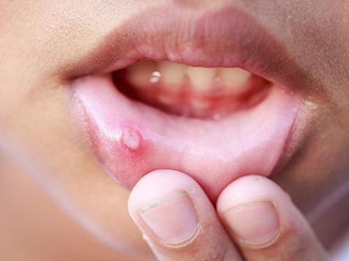 张仲景有哪些方子可以治口腔溃疡,用一种药治口腔溃疡