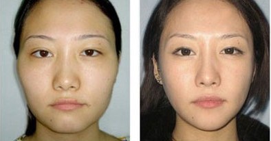 自体脂肪丰太阳穴和玻尿酸哪个好,为什么玻尿酸填充越多越持久