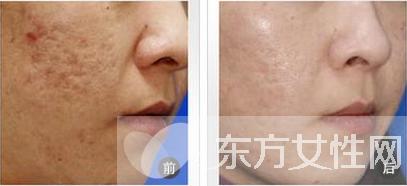 怎么祛痘疤最好的方法,祛痘印痘疤最有效的方法