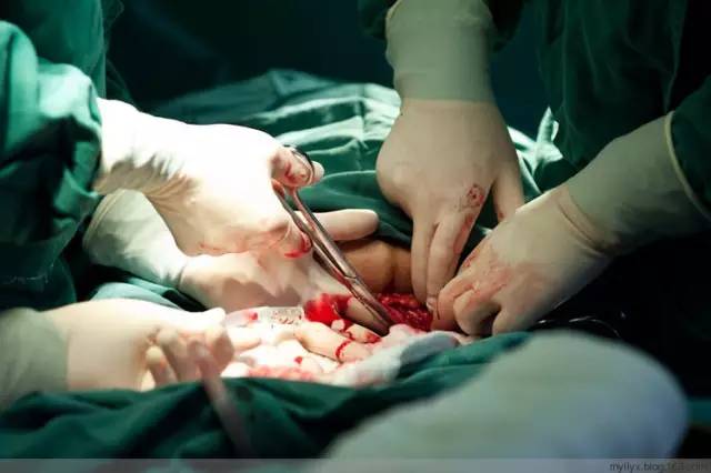 剖腹产恢复很好的照片,剖腹产完全恢复照片