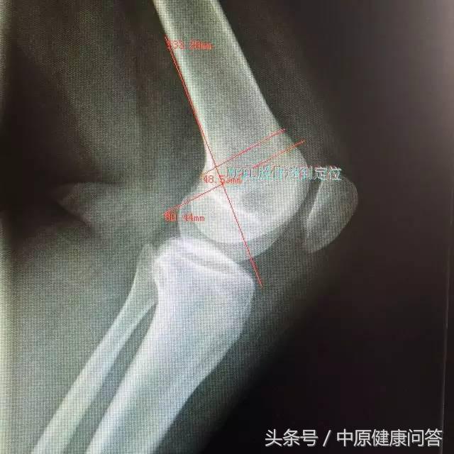 先天性习惯性流产,习惯性流产后期有可能会好吗