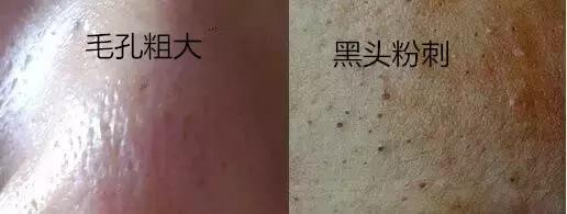 全网去黑头口碑最好的办法,目前公认去黑头最好的办法