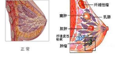 乳腺囊肿12mmx10mm严重吗,乳腺囊肿会自动消失吗