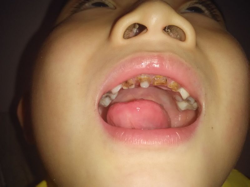 宝宝乳牙神经坏死会影响换牙吗,乳牙龋齿严重牙神经坏死