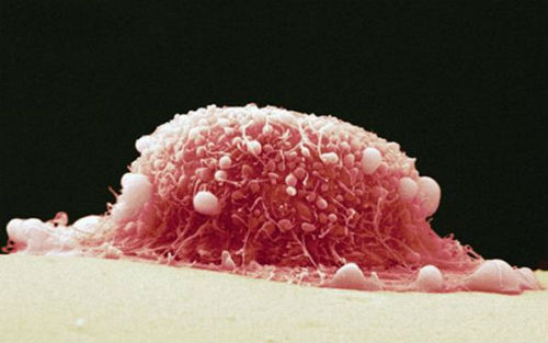 尖锐湿疣,中医内外合治有3个原则