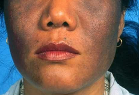 脸老感觉洗不干净,脸上的黑斑很多年了能去除吧