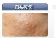 如何有效避免或减少青春痘的出现,避免青春痘误区彻底治疗青春痘