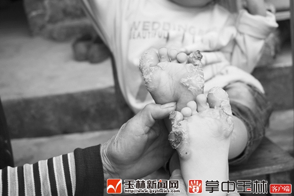 瘆人！容县4岁男孩“头部龟裂”