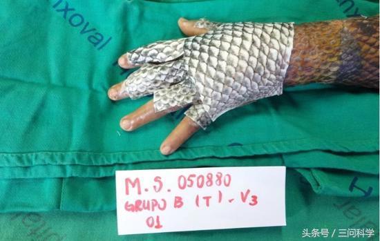 烫伤了不痛,鱼皮治疗烫伤疤痕可以吗