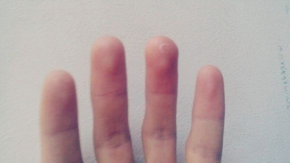 血热头发白怎么可以治,血热手指爆皮怎么办