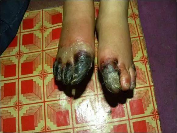 冬天长冻疮的最好方法,冬天治冻疮最好的方法