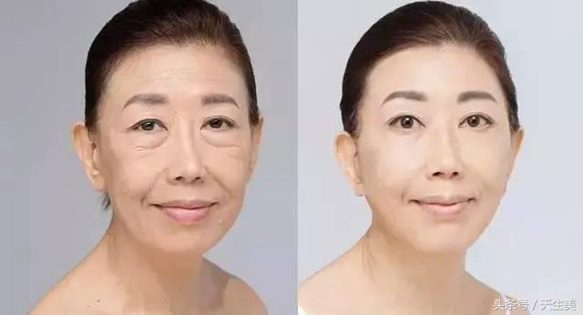 超声刀怎么样啊 (超声刀分享)