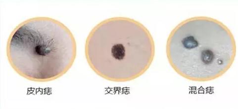 点痣会不会黑色素扩散越来越多,点痣会引起恶性肿瘤吗