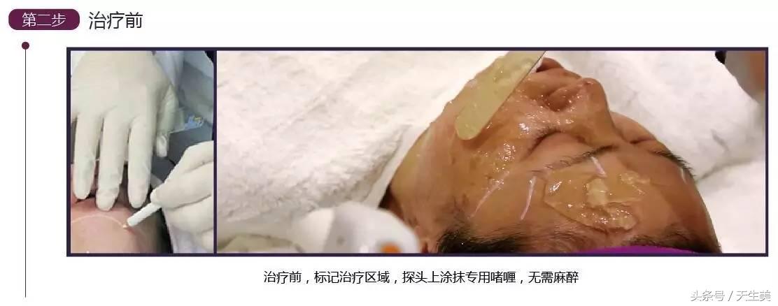 超声刀怎么样啊 (超声刀分享)