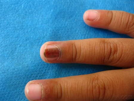 指甲都会有什么病症,指甲也会病变么