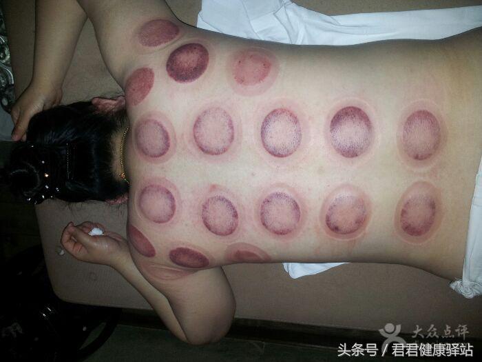拔火罐印记是灰白颜色为什么,拔火罐的印子颜色代表了什么